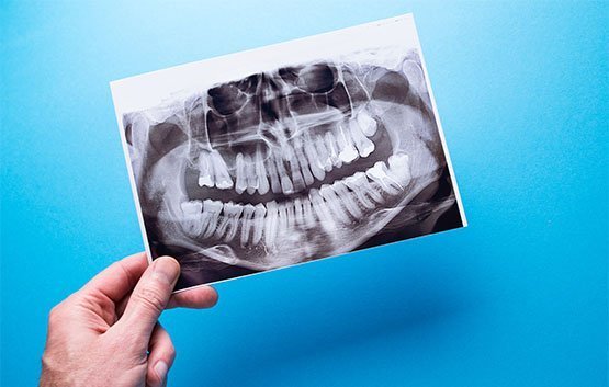 bone-grafting-leichhardt