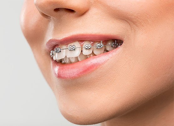 braces-leichhardt