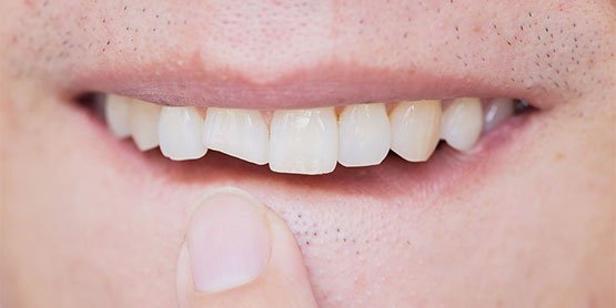 broken-tooth-leichhardt