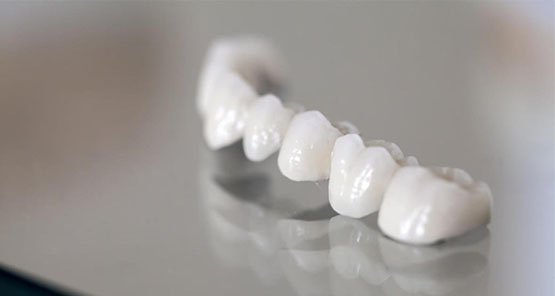 dental-bridges-blurb-leichhardt