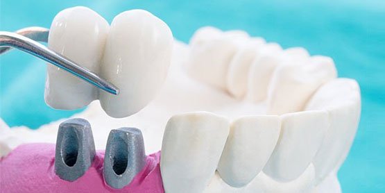 dental-crowns-blurb-leichhardt