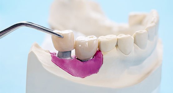 dental crowns blurb leichhardt