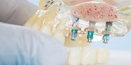 dental-implants-blurb-leichhardt