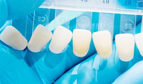dental-veneers-leichhardt