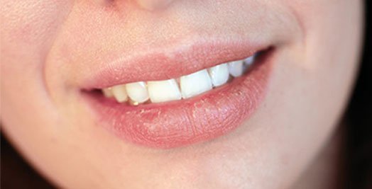 dry-mouth-treatment-leichhardt