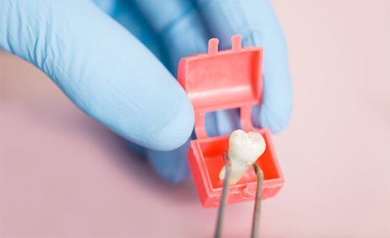 reasons-for-extracting-wisdom-teeth-leichhardt