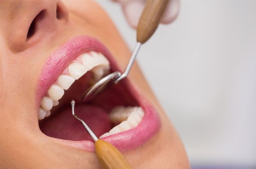 tooth-decay-leichhardt