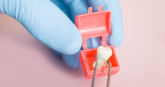 wisdom-tooth-extraction-complications-leichhardtjpg