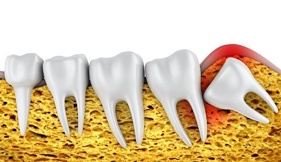 wisdom-tooth-extraction-leichhardt