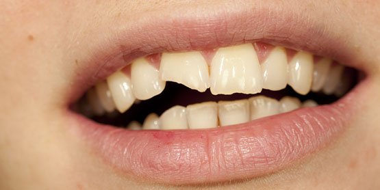 causes-of-broken-tooth-leichhardt