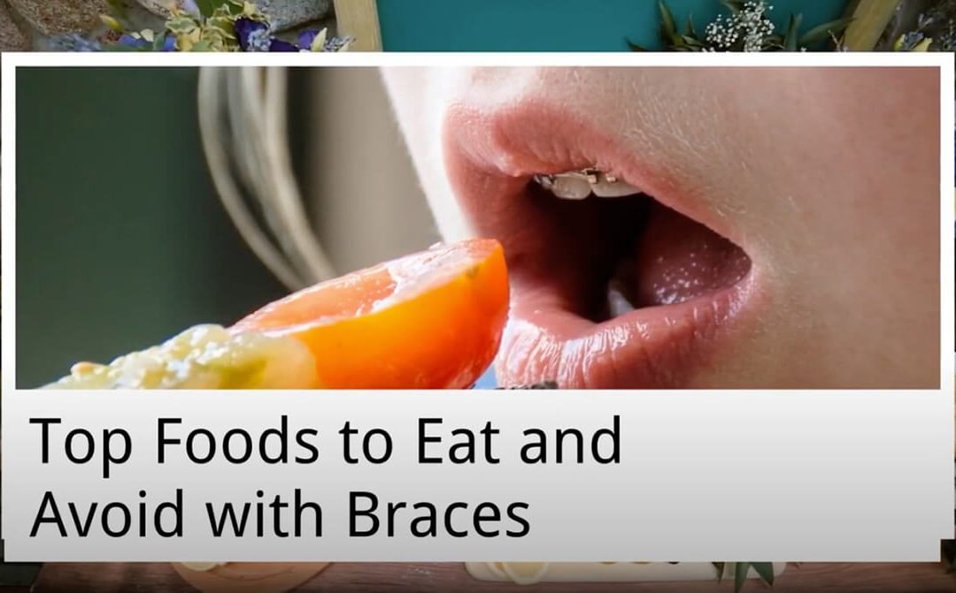 Top Foods to Eat and Avoid with Braces from My Local Dentists Leichhardt