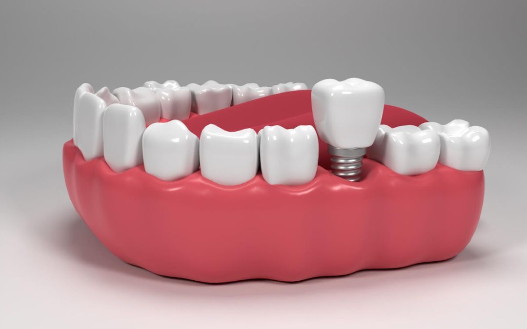 Tooth Replacement Options – What Are My Choices?