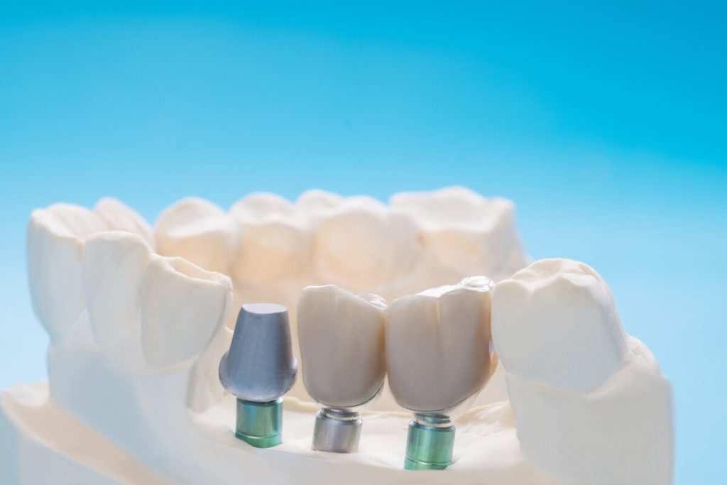 how long does the dental implant procedure take