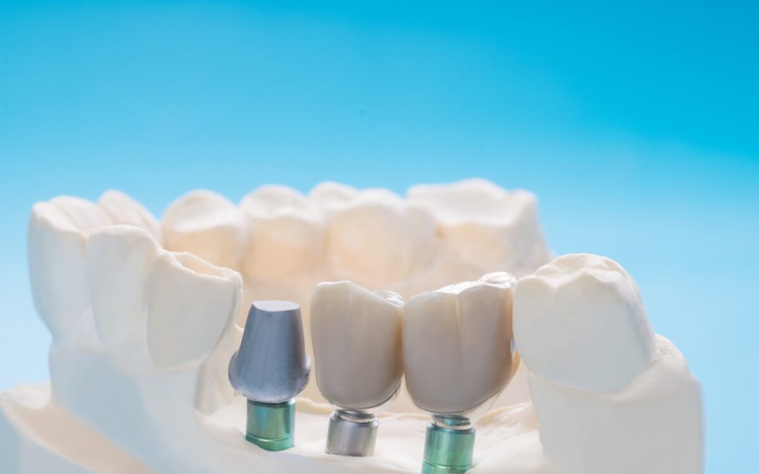 How Long Does The Dental Implant Procedure Take?