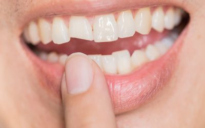 Chipped Tooth Emergency: What To Do and Treatment Options