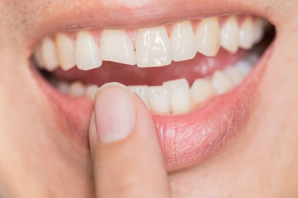 Chipped Tooth Emergency: What To Do and Treatment Options